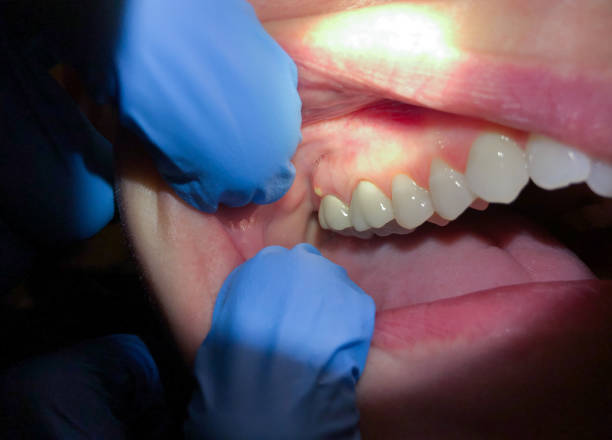 Best Emergency Tooth Extraction in Lake Arrowhead, ME